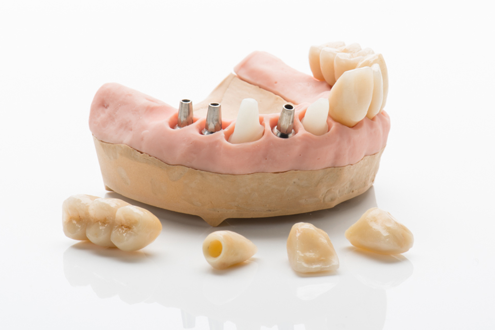 Ein Modell-Gebiss mit offenen Implantaten